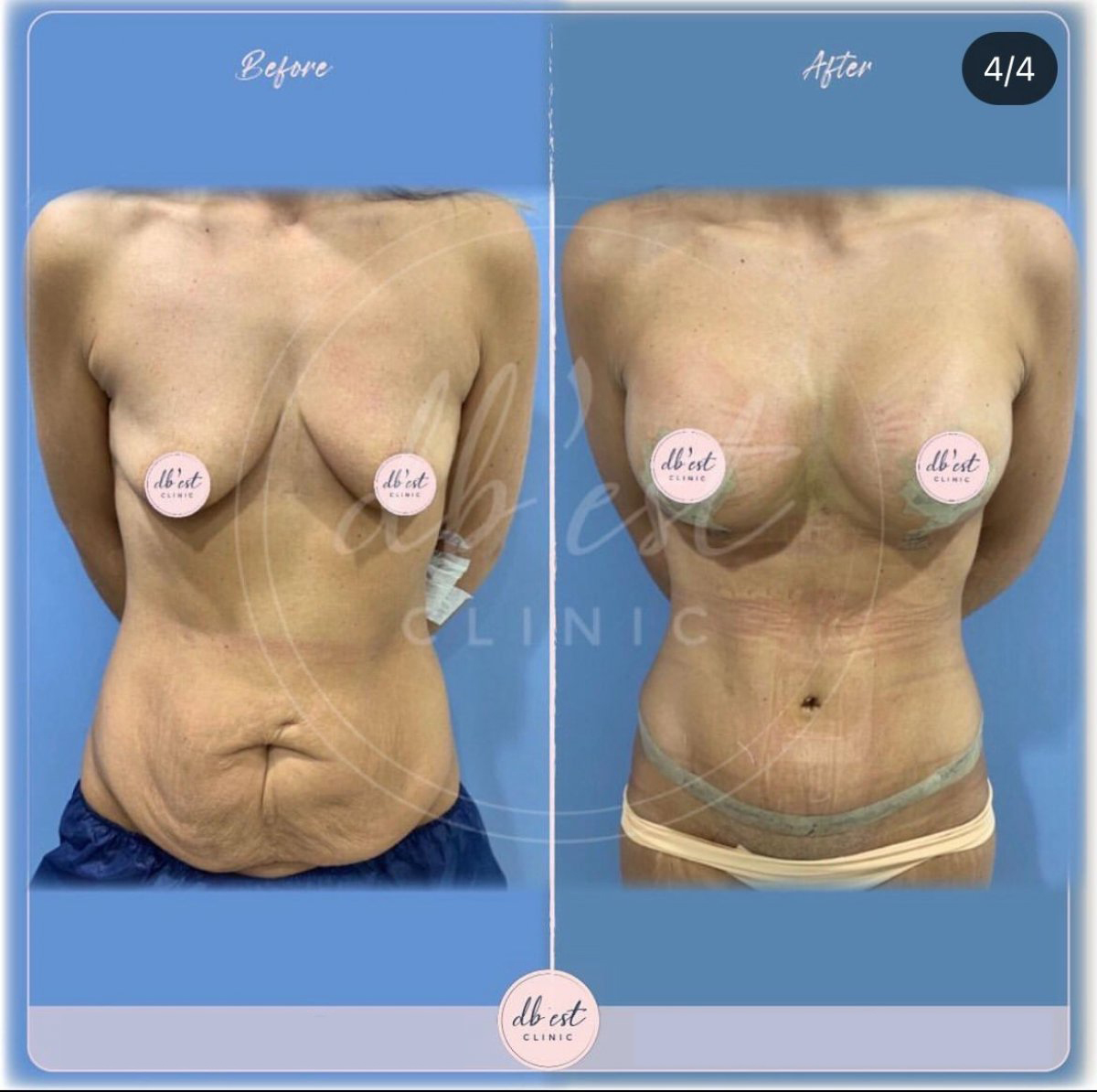 cirugía de mommy makeover en turquía, fotos de antes y despues de cirugía