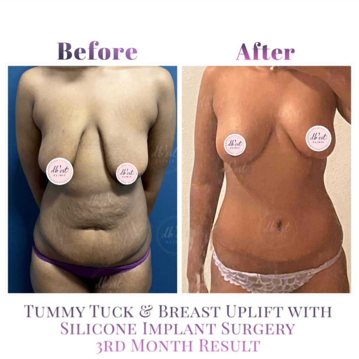 fotos de cirugía de mommy makeover en turquía, antes y después de las cirugías