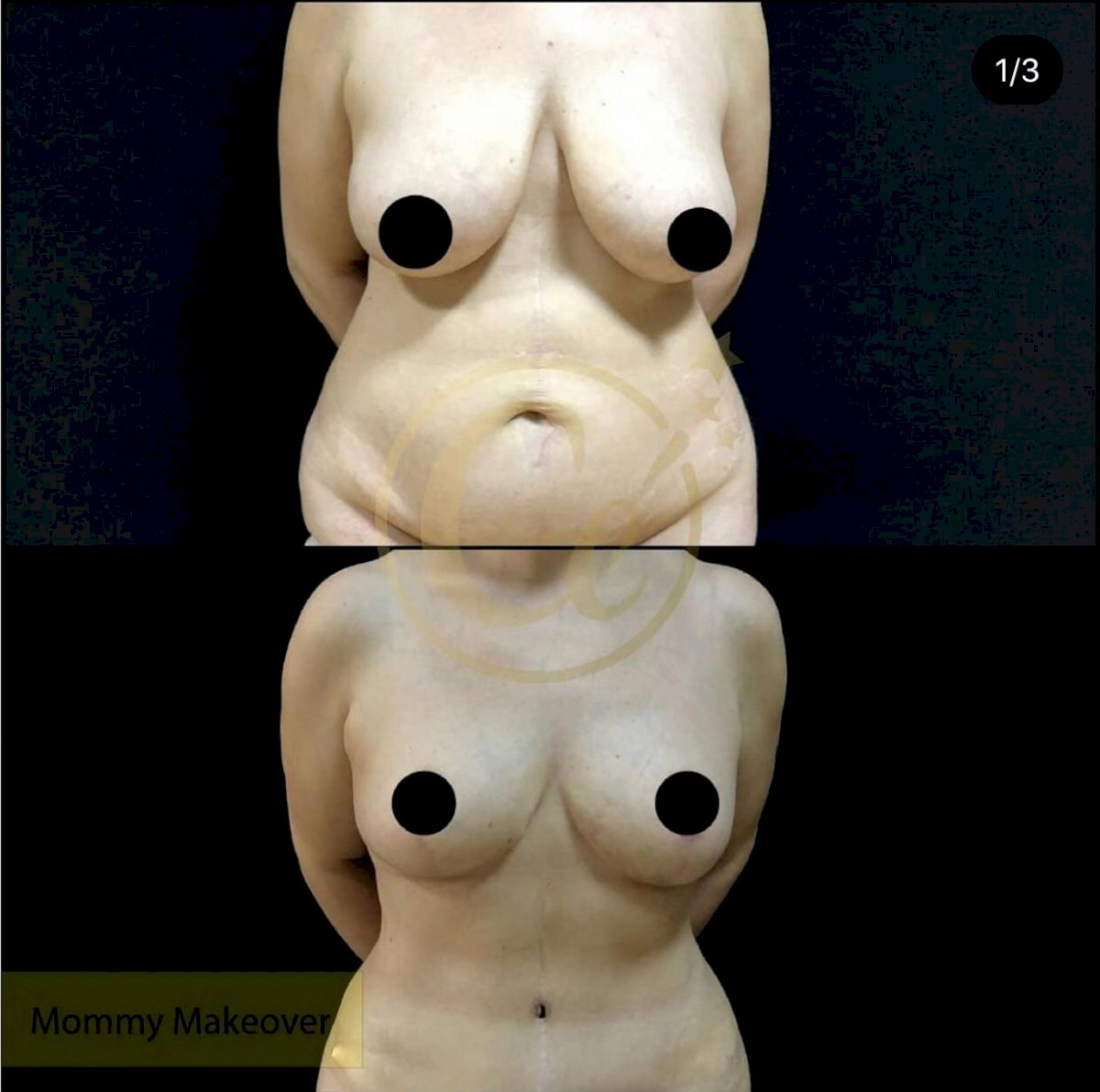 fotos de antes y después de las cirugías de cambio de imagen de mamá en turquía