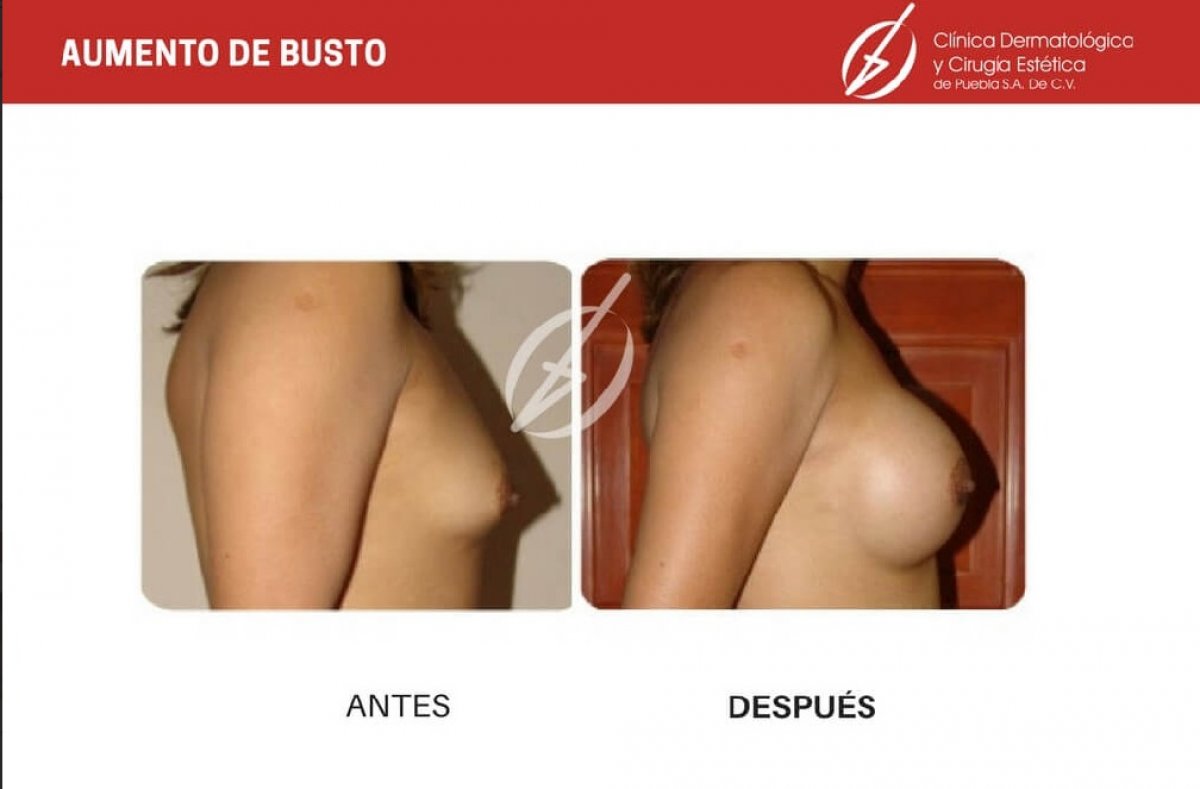 cirugía de aumento de senos, foto de antes y después