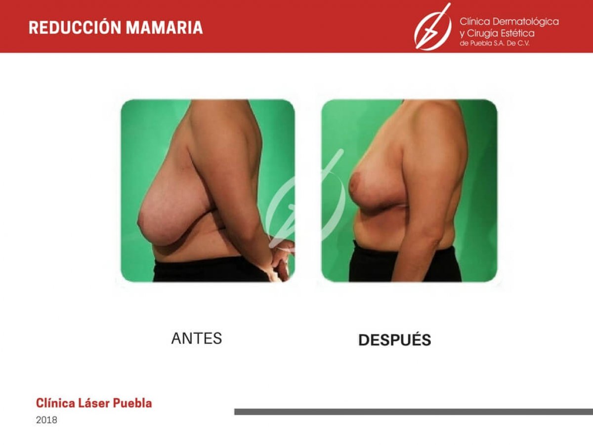 cirugía de reducción de senos, foto de antes y después
