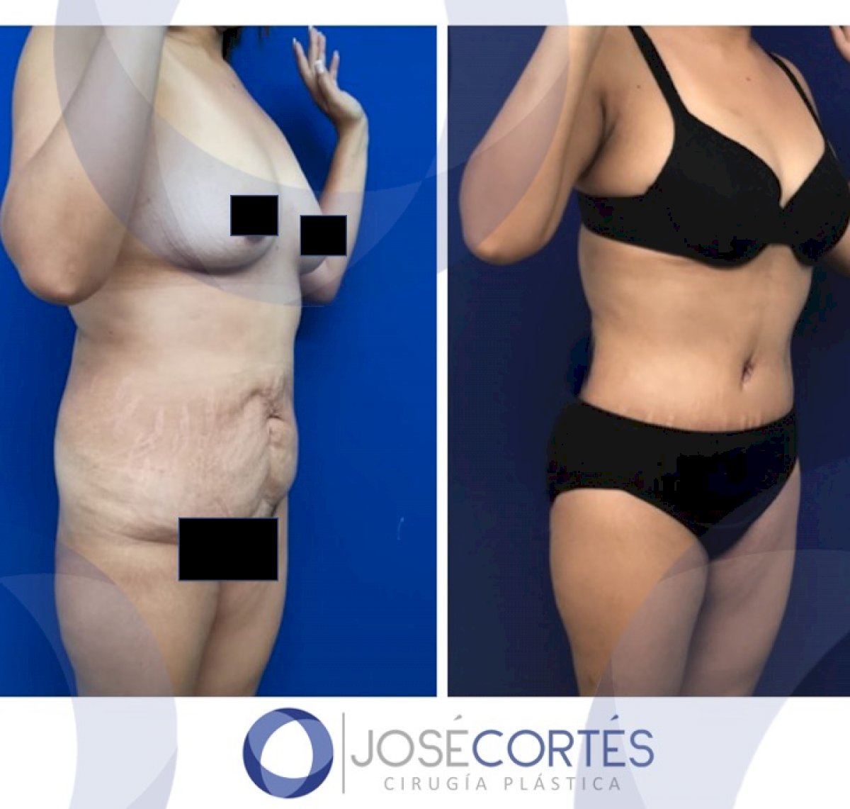 cirugía de abdominoplastia, foto de antes y después