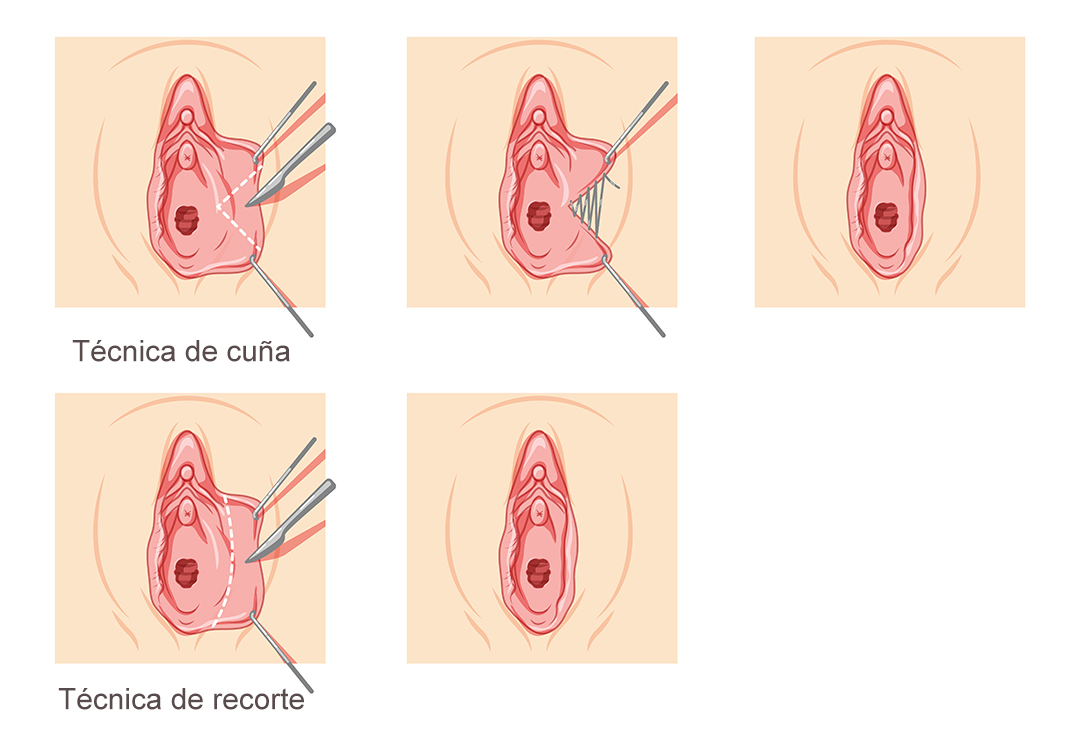 técnicas de labioplastia