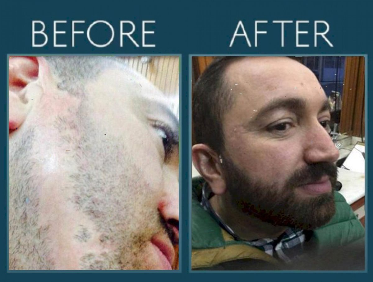 operasi transplantasi janggut