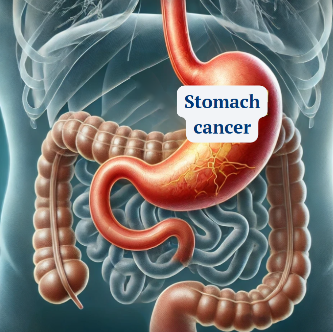 stomach cancer