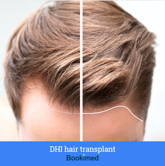 Prosedur transplantasi rambut DHI menunjukkan teknik penanaman langsung