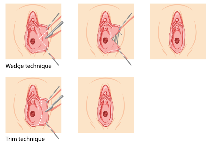 BAGAIMANA labiaplasty dilakukan - reseksi wedge