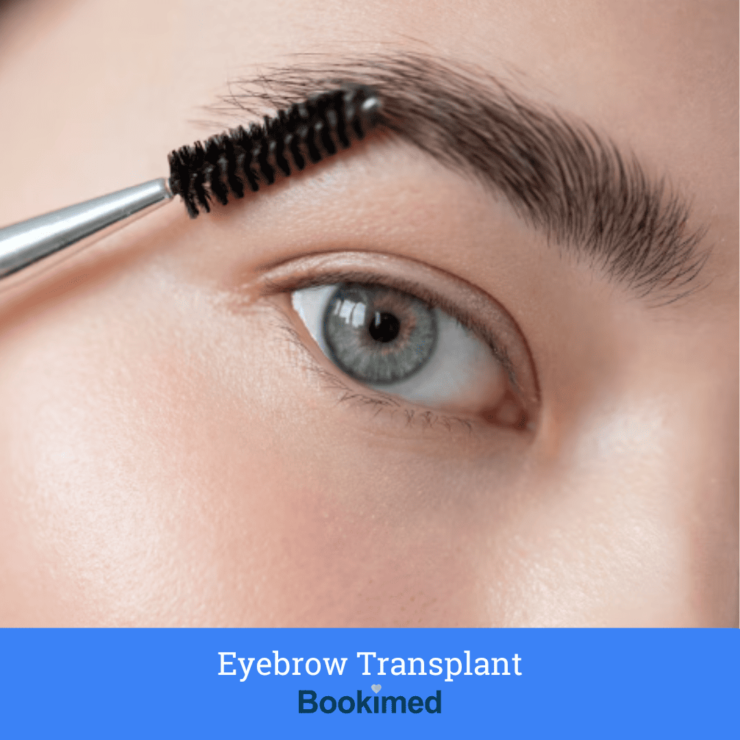 eyebrow transplantation from donor area