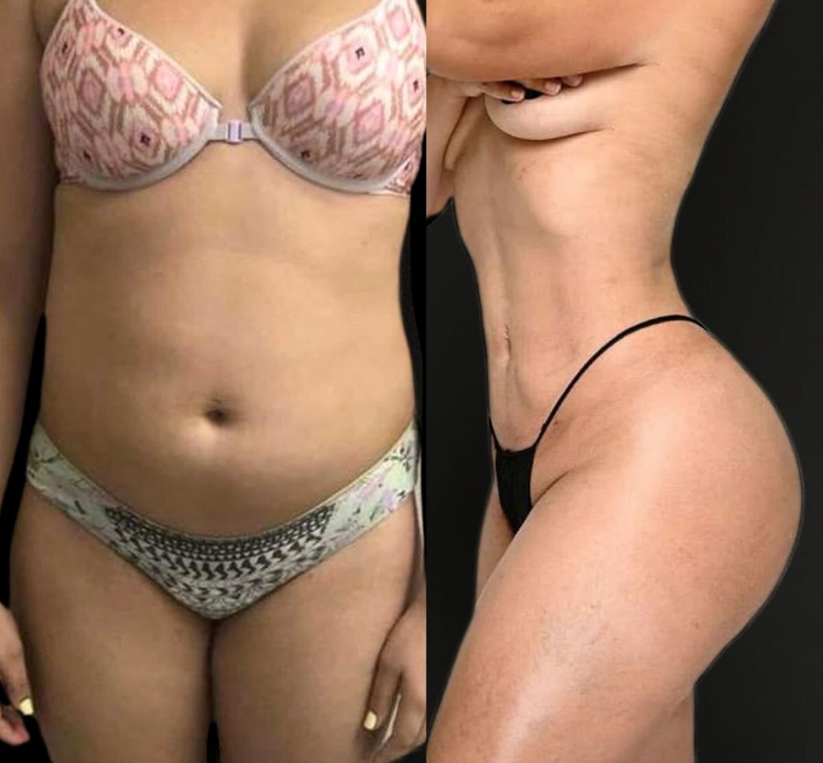  Before And After Mommy Makeover Pictures