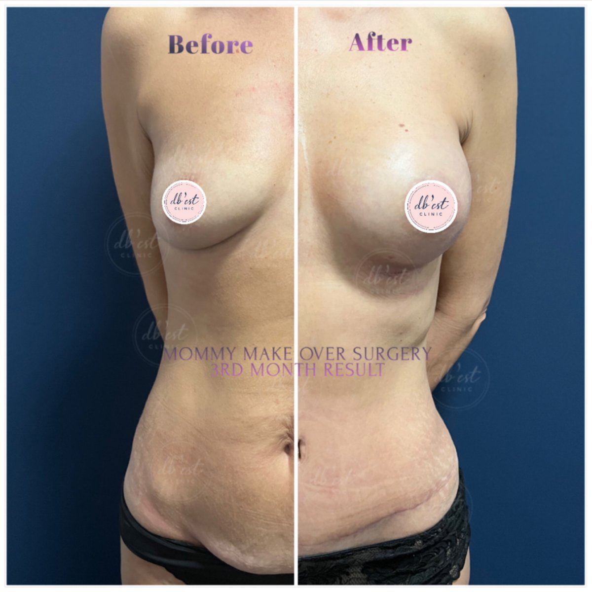 Before And After Mommy Makeover Pictures