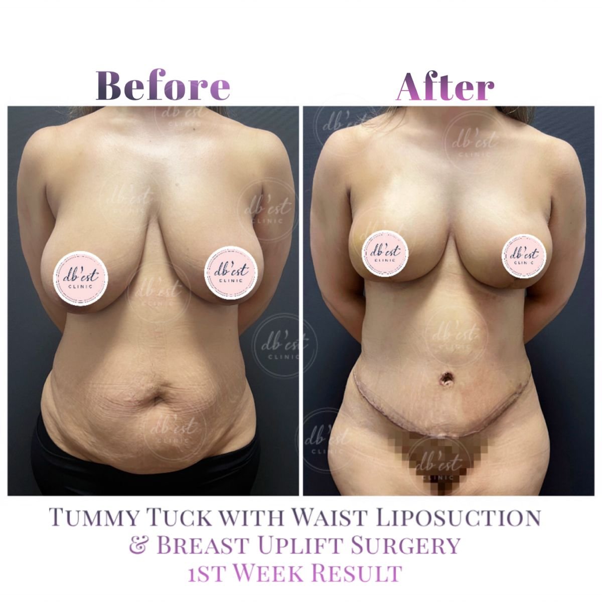  Before And After Mommy Makeover Pictures