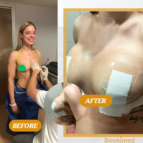 breast implants reasl results