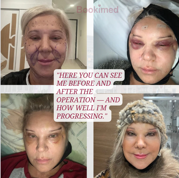 face lift results in turkey