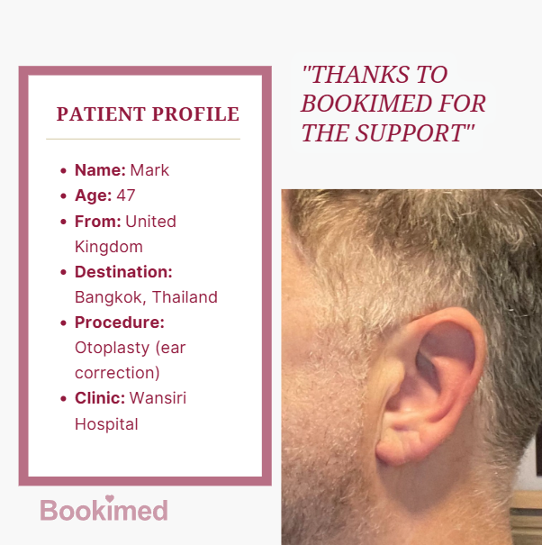 otoplasty before and after