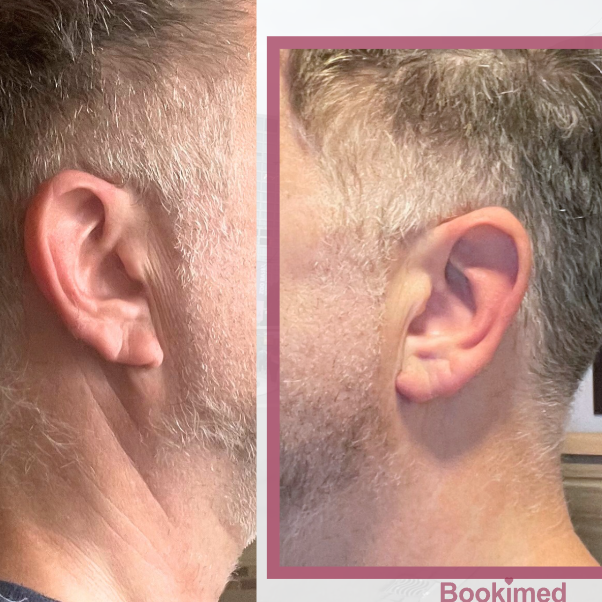 otoplasty before and after