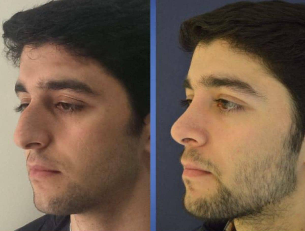 Rhinoplasty in Turkey