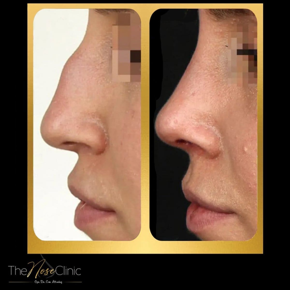 Woman Afrer Rhimoplasty