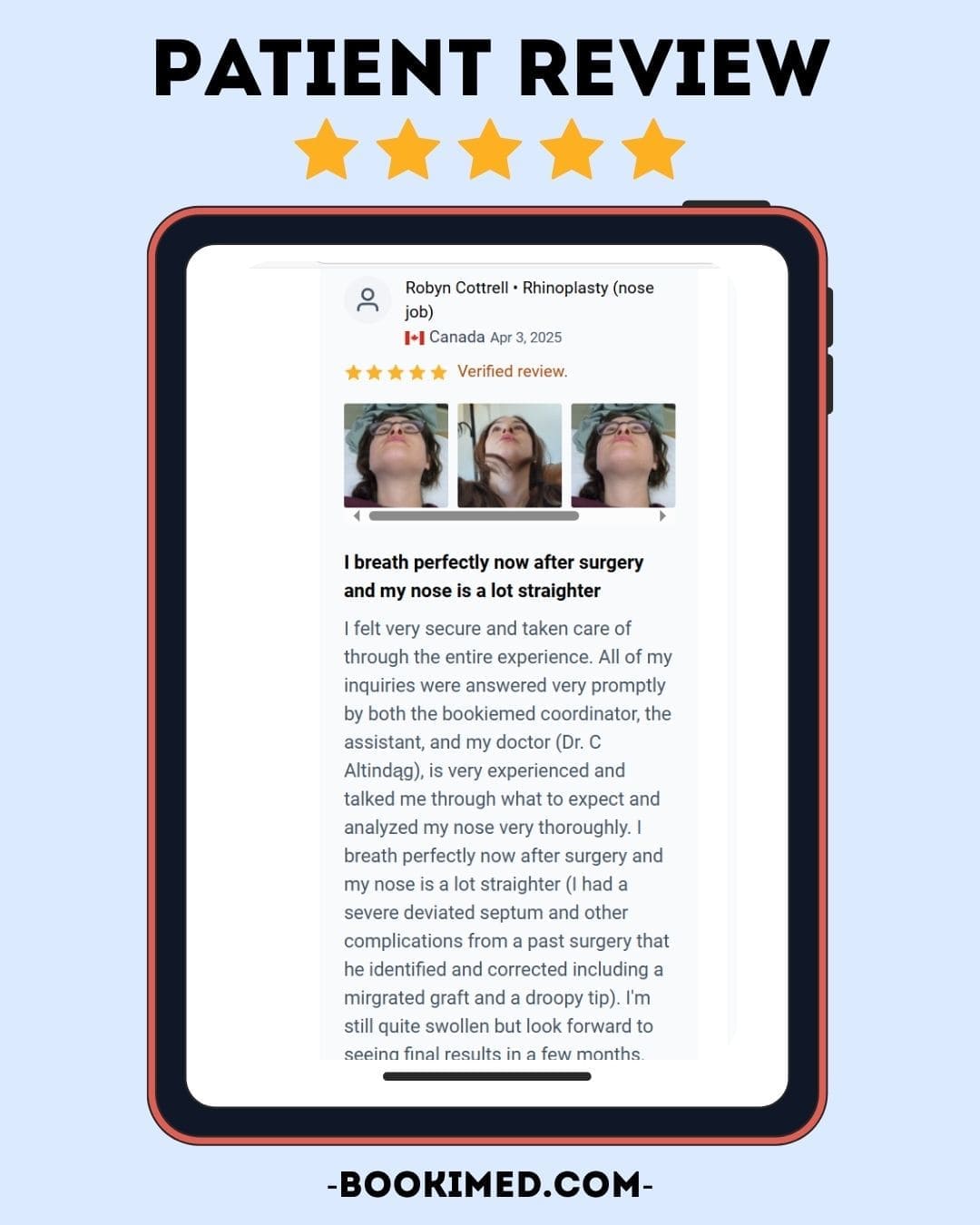 Rhinoplasty Review Patient From Canada