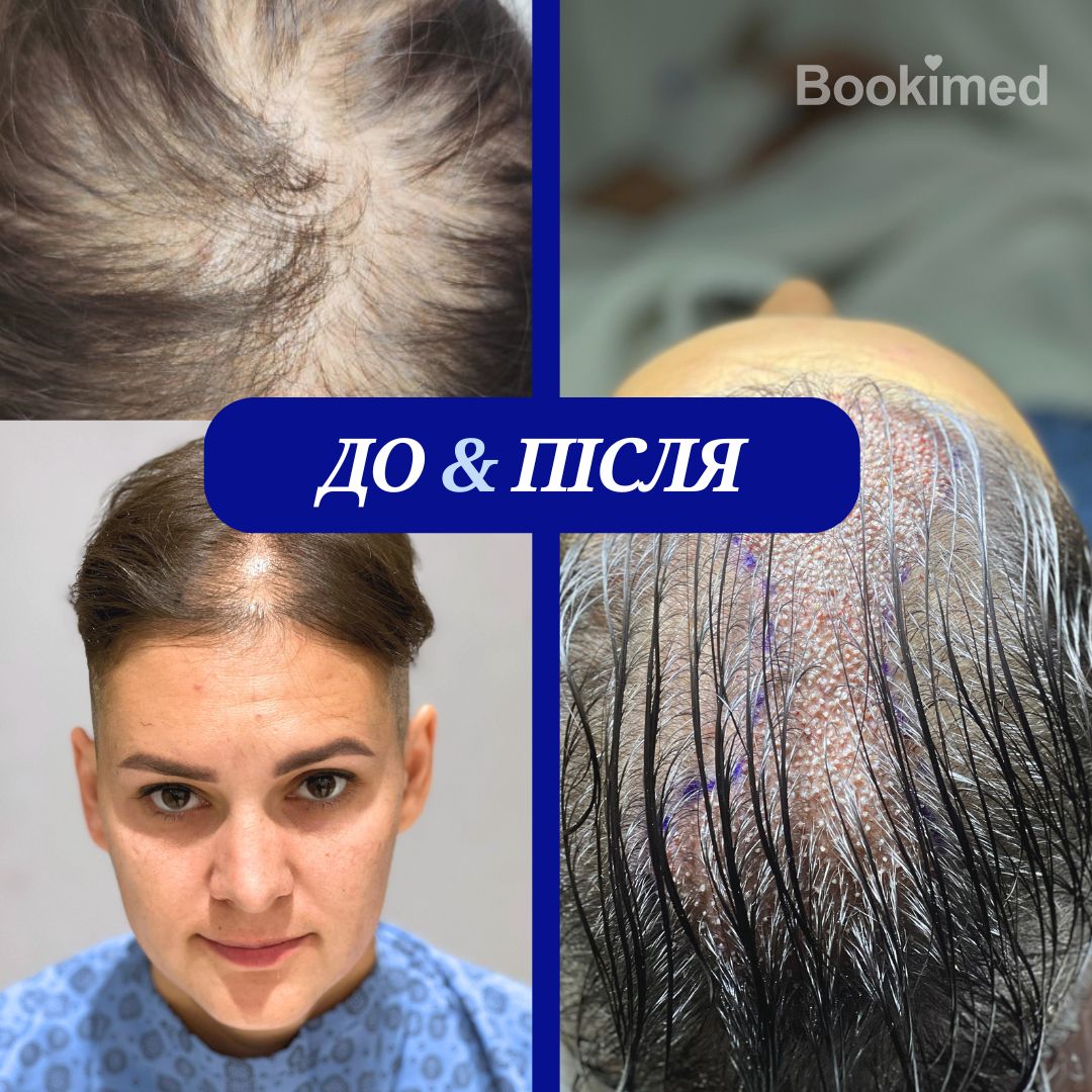 результати пересадки волосся в турецький клініці