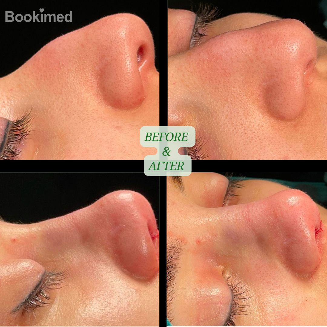 before and after nose job turkey