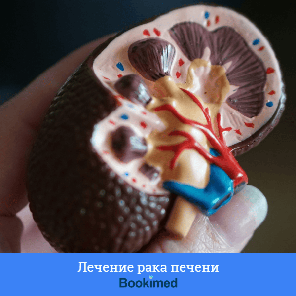 илюстрация колоректального рака