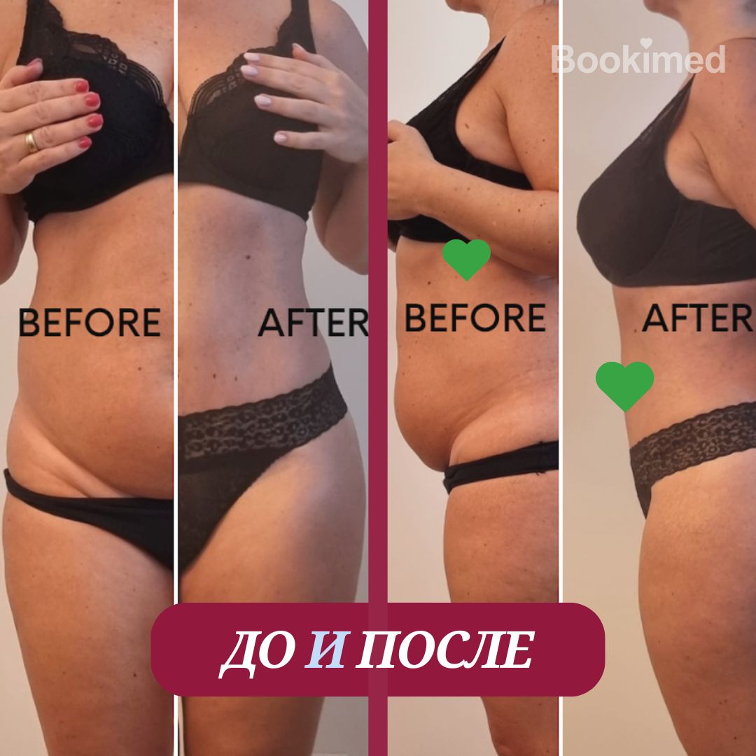 Липосакция живота до и после