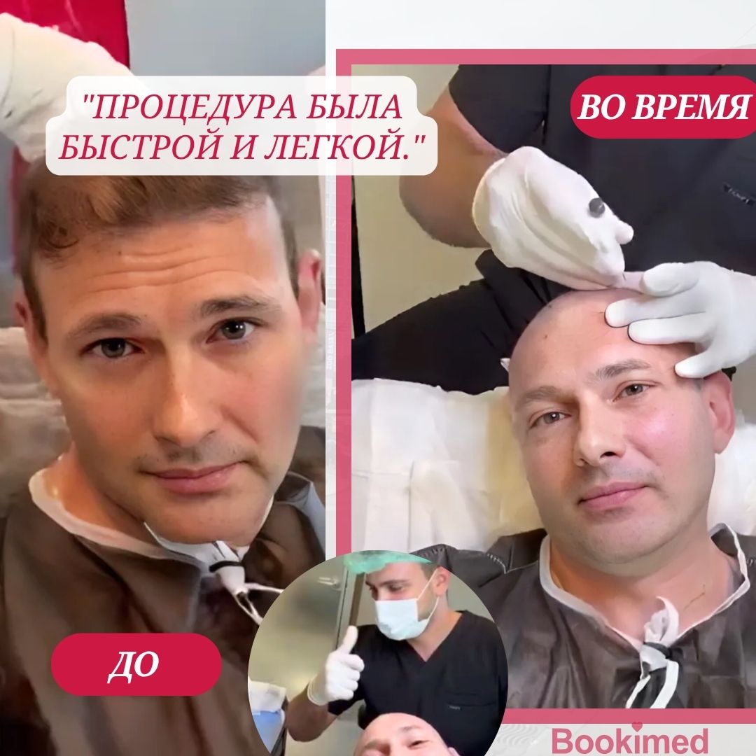 отзыв о пересадке волос