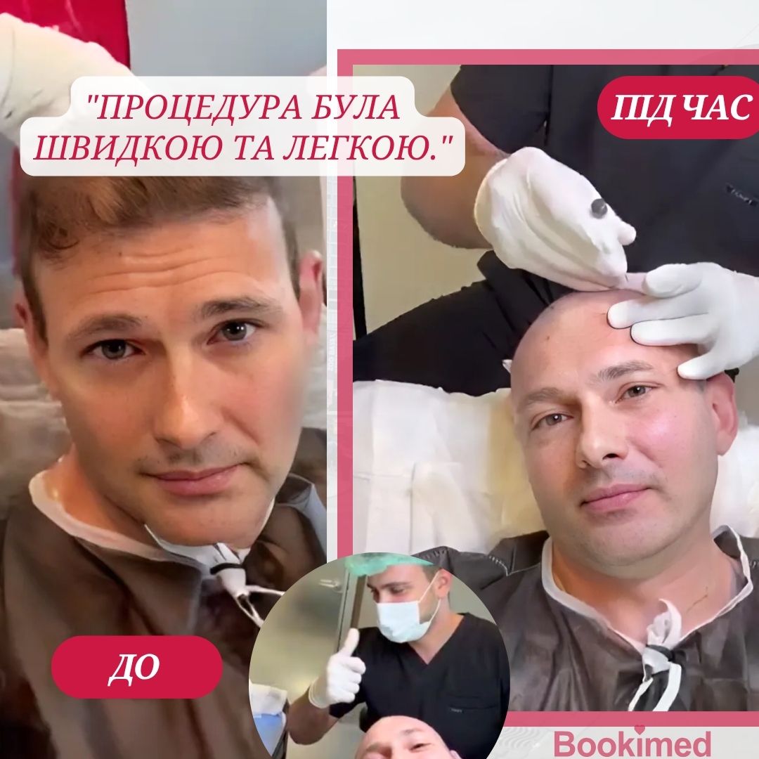 відгук про пересадку волосся