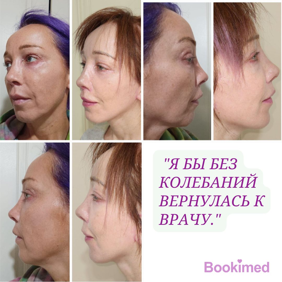 фото до и после подтяжки лица