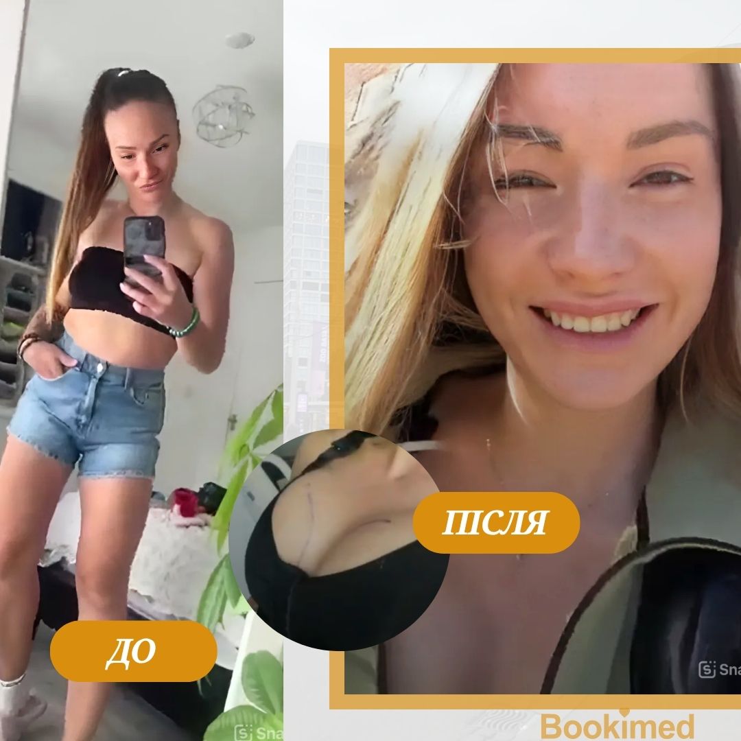 грудні імпланти в туреччині