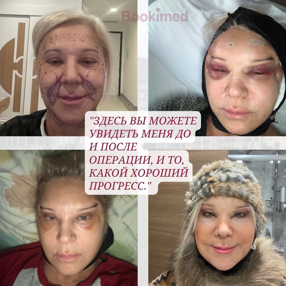 Результаты подтяжки лица в турции