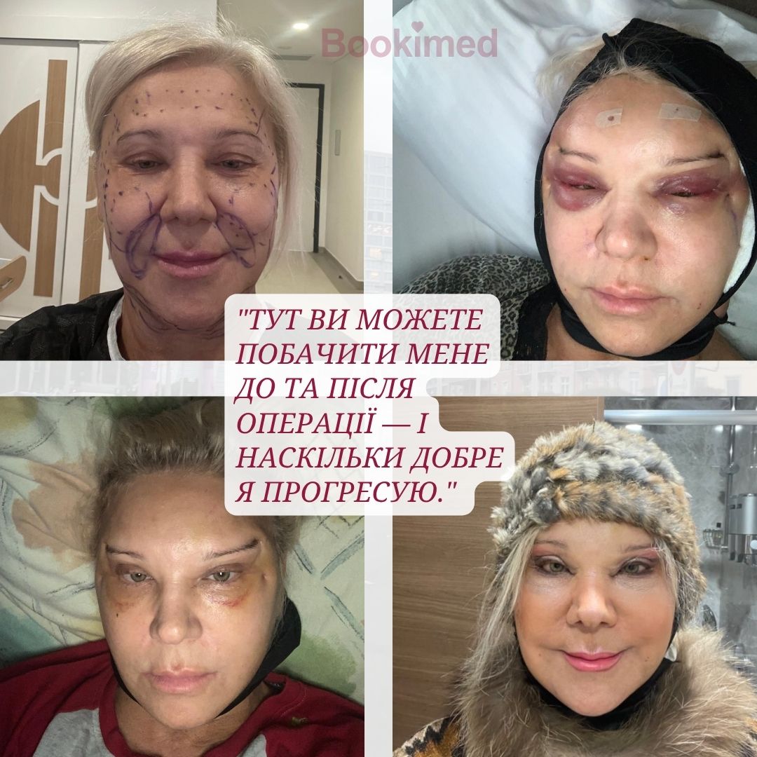 Результати підтяжки обличчя в туреччині