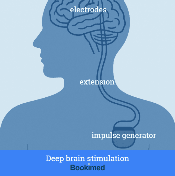deep brain stimulation surgery 
