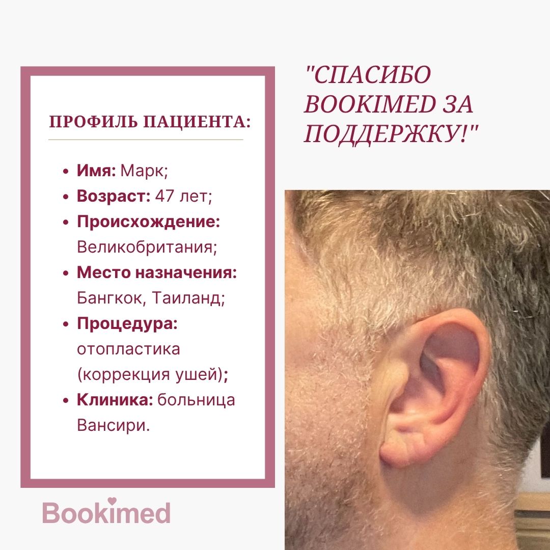 отопластика до и после