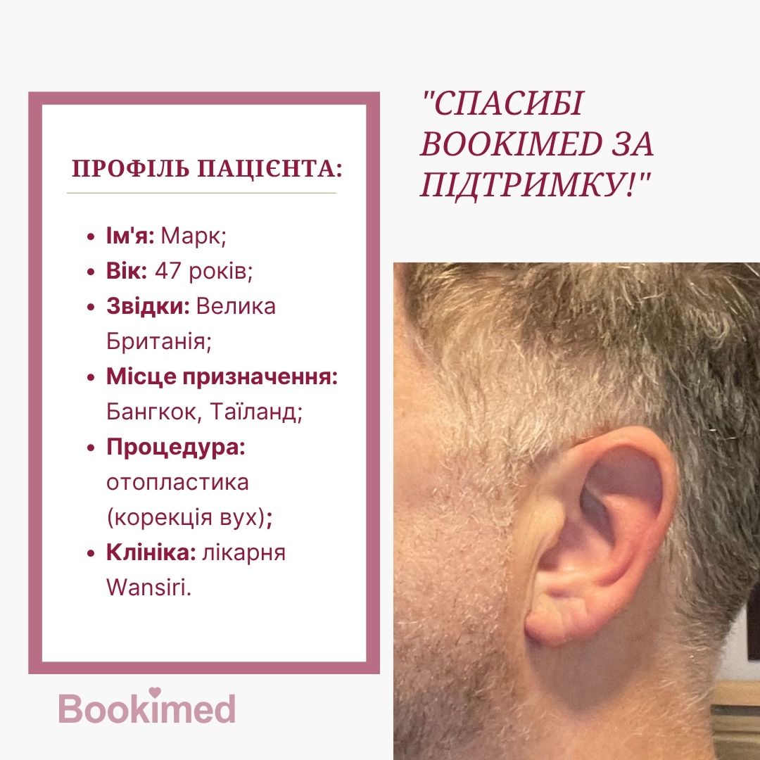 отопластика до та після