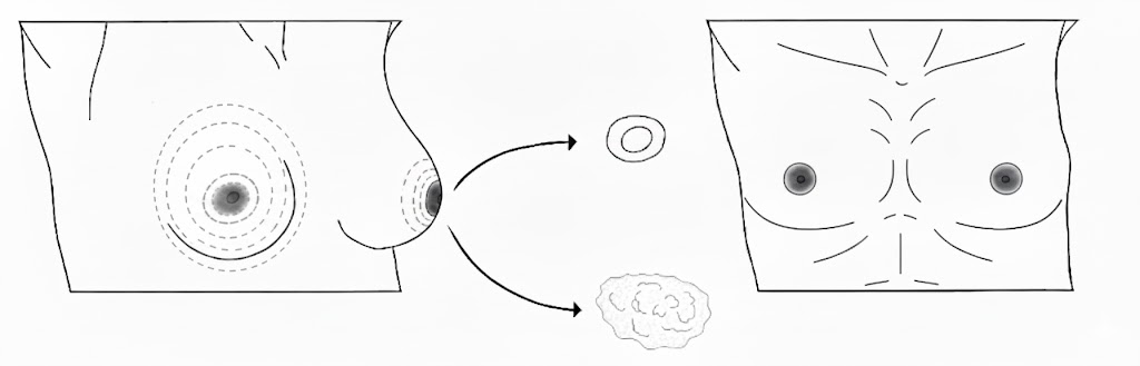 periareolar top surgery