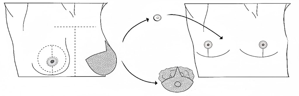 inverted t top surgery