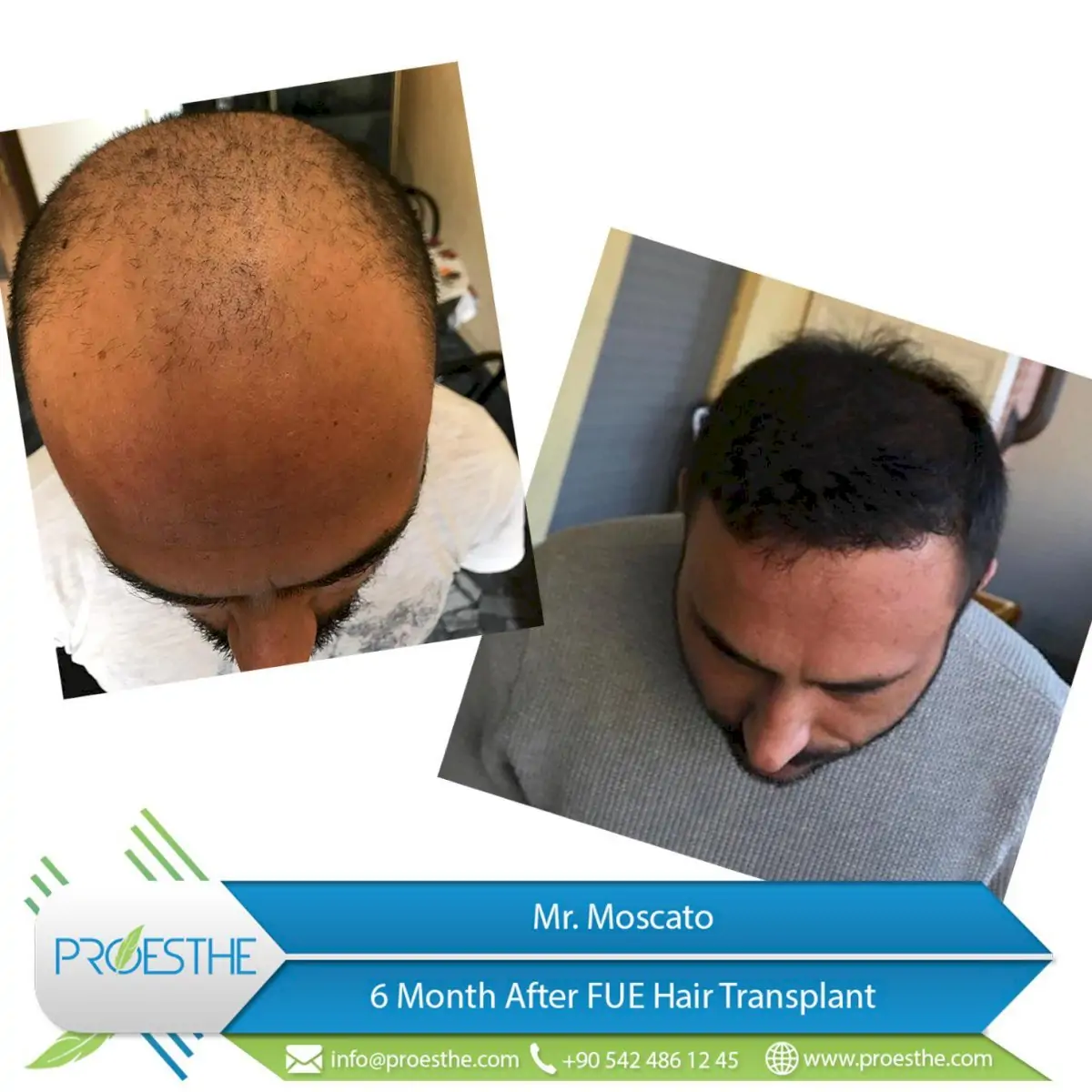 Proesthe Hair Transplant Center
