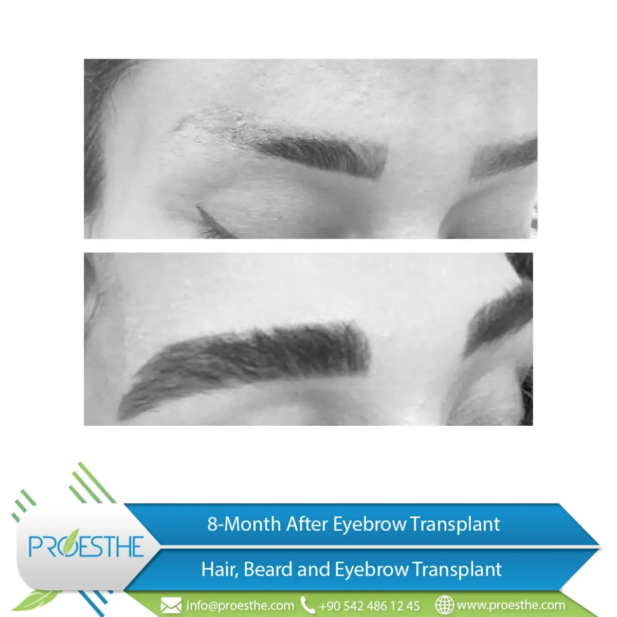 Proesthe Hair Transplant Center