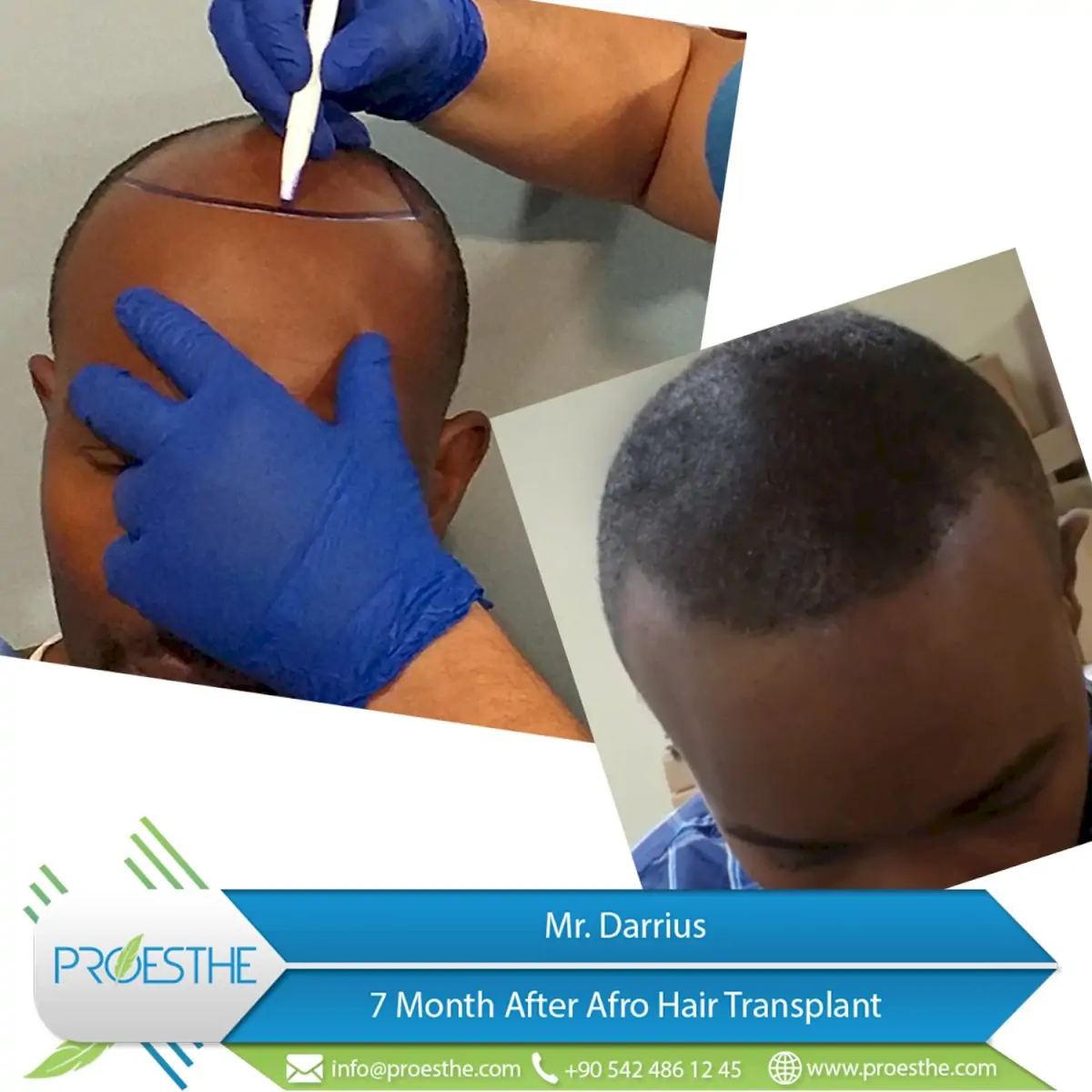 Proesthe Hair Transplant Center