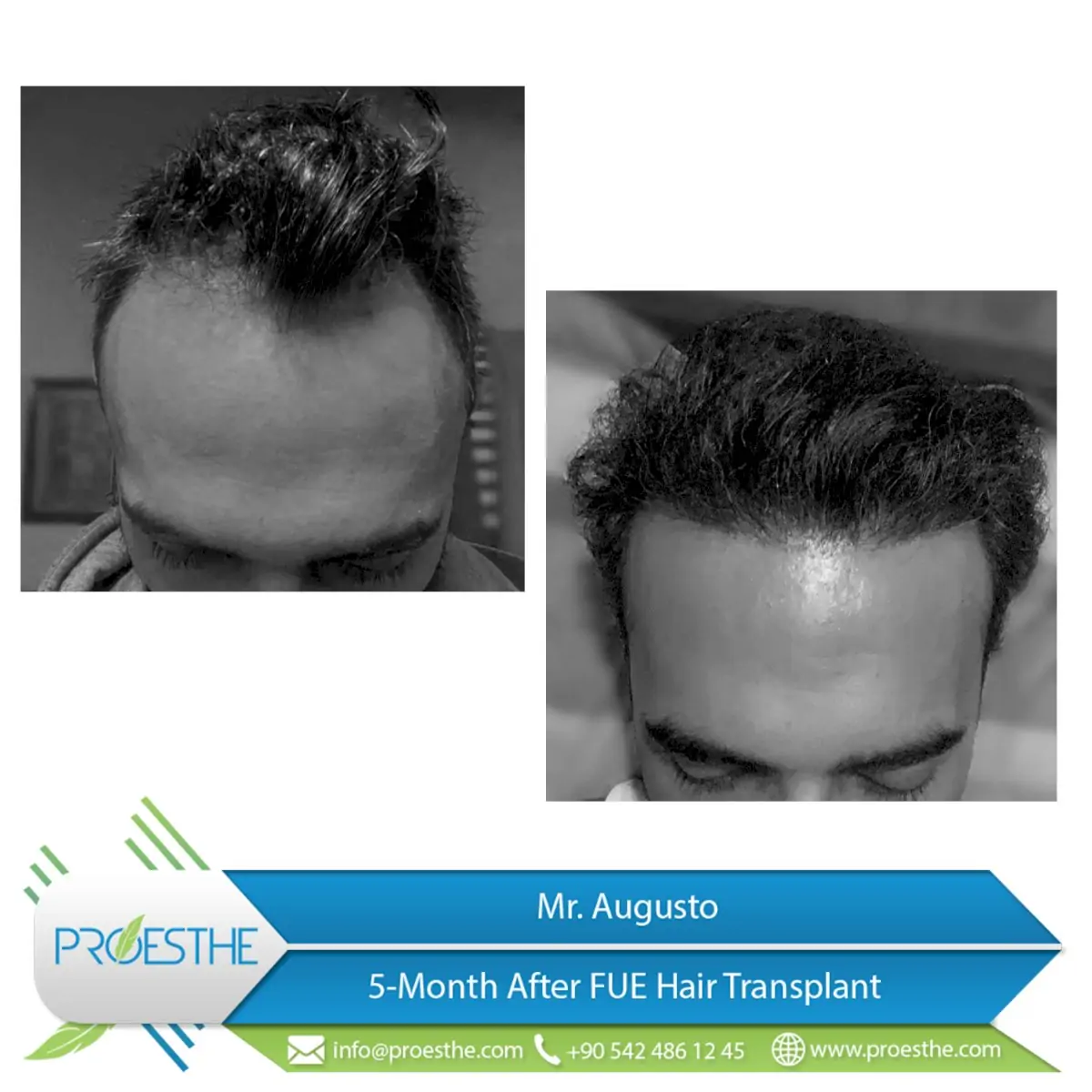 Proesthe Hair Transplant Center