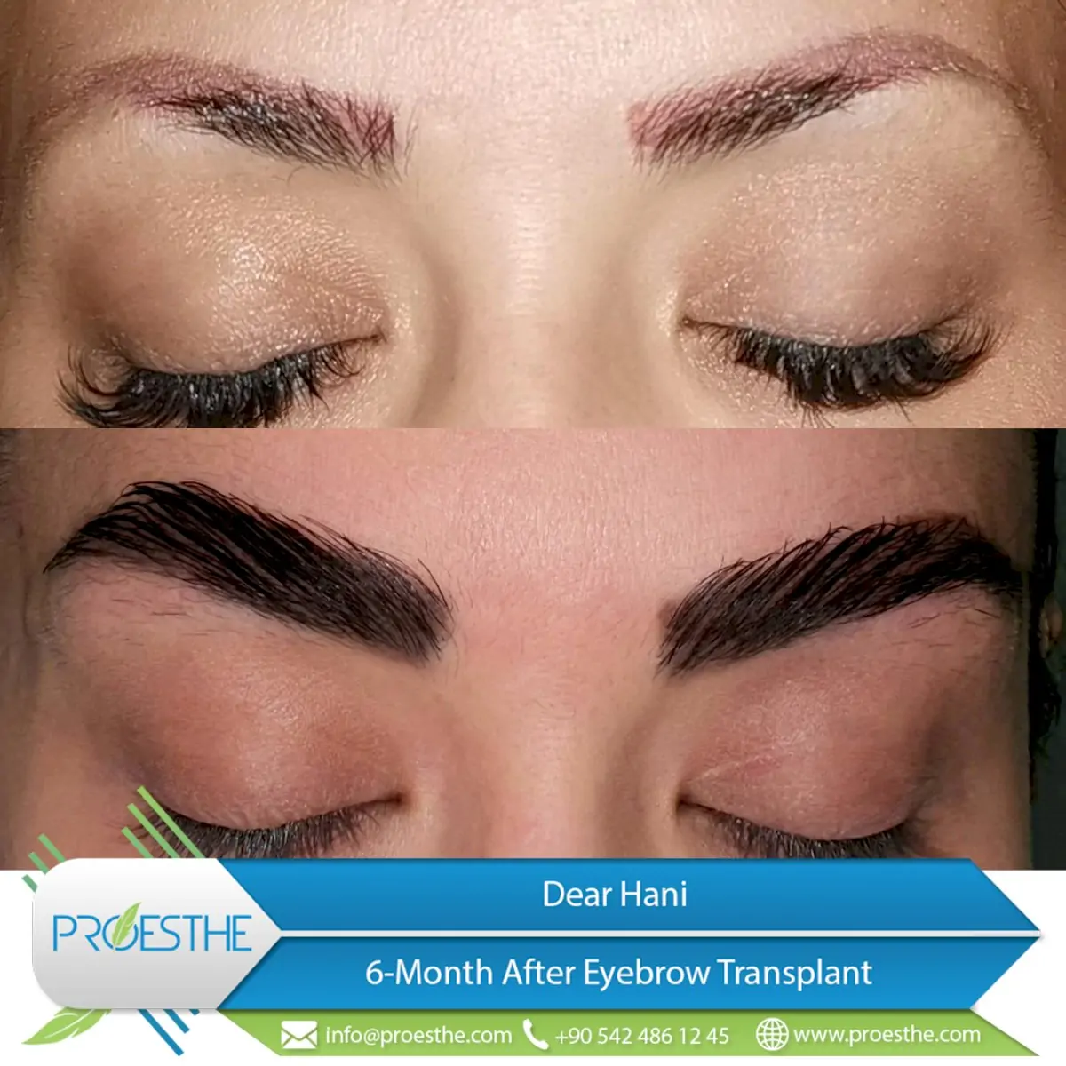 Proesthe Hair Transplant Center