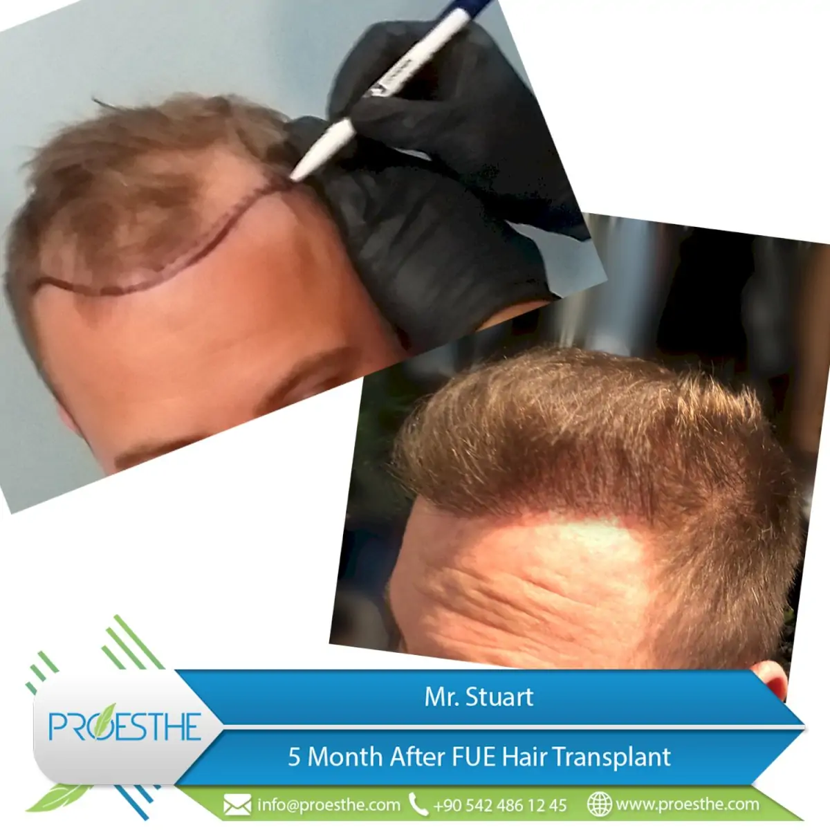 Proesthe Hair Transplant Center
