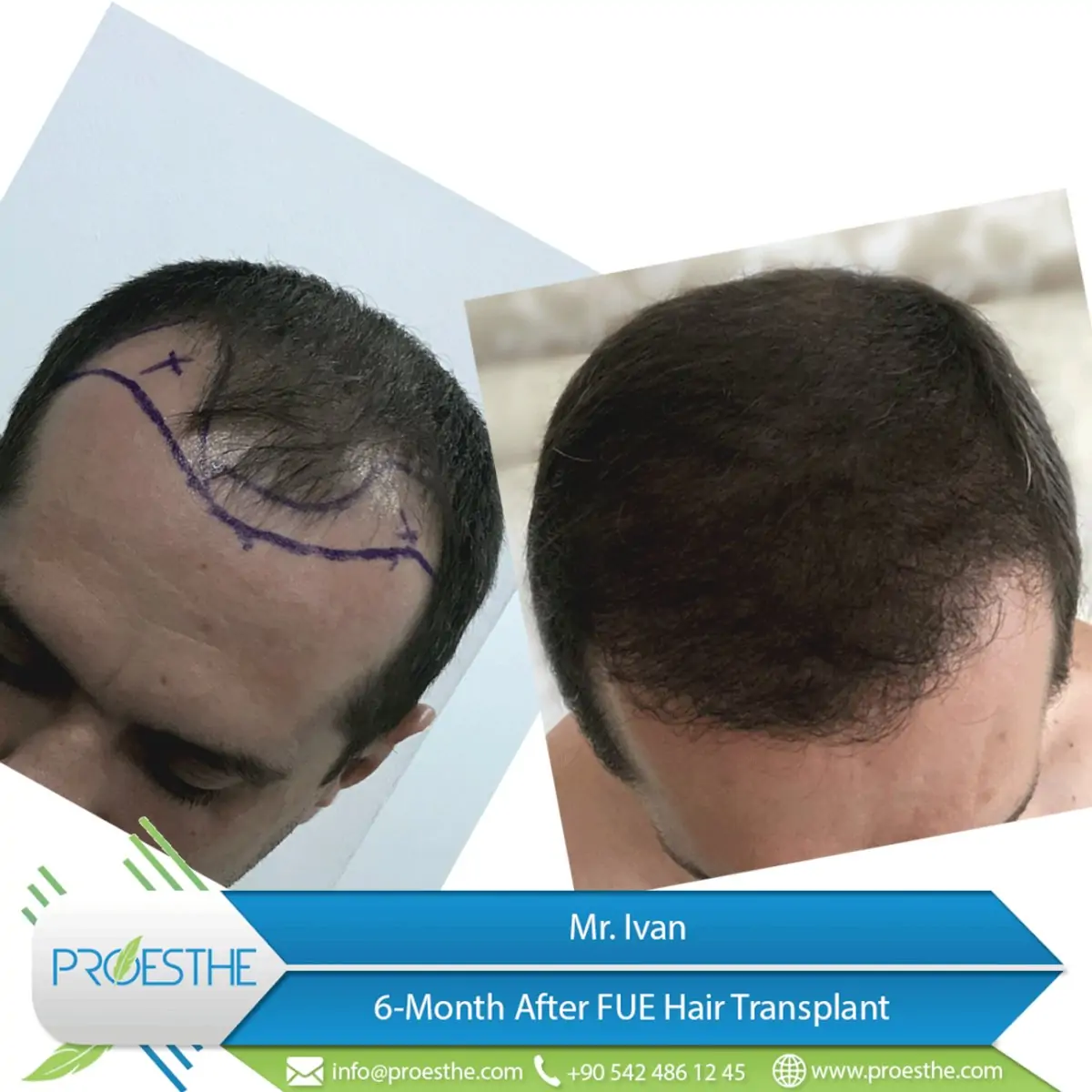 Proesthe Hair Transplant Center