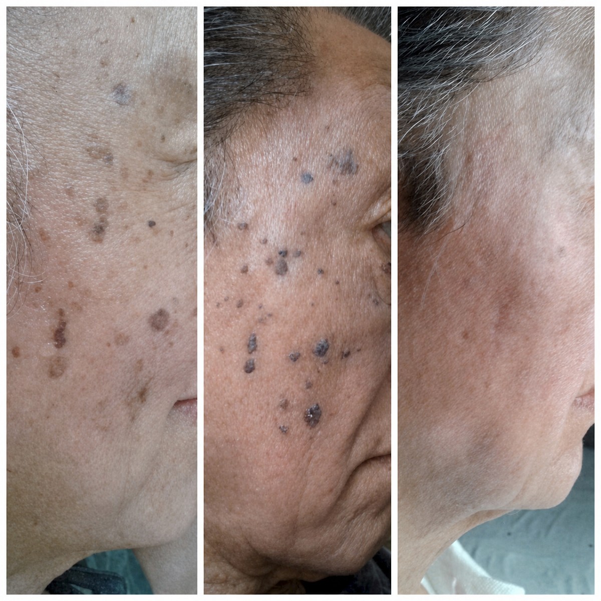 Resultados de rejuvenecimiento facial láser antes y después en Lyfe Medical Wellness, mejora de manchas