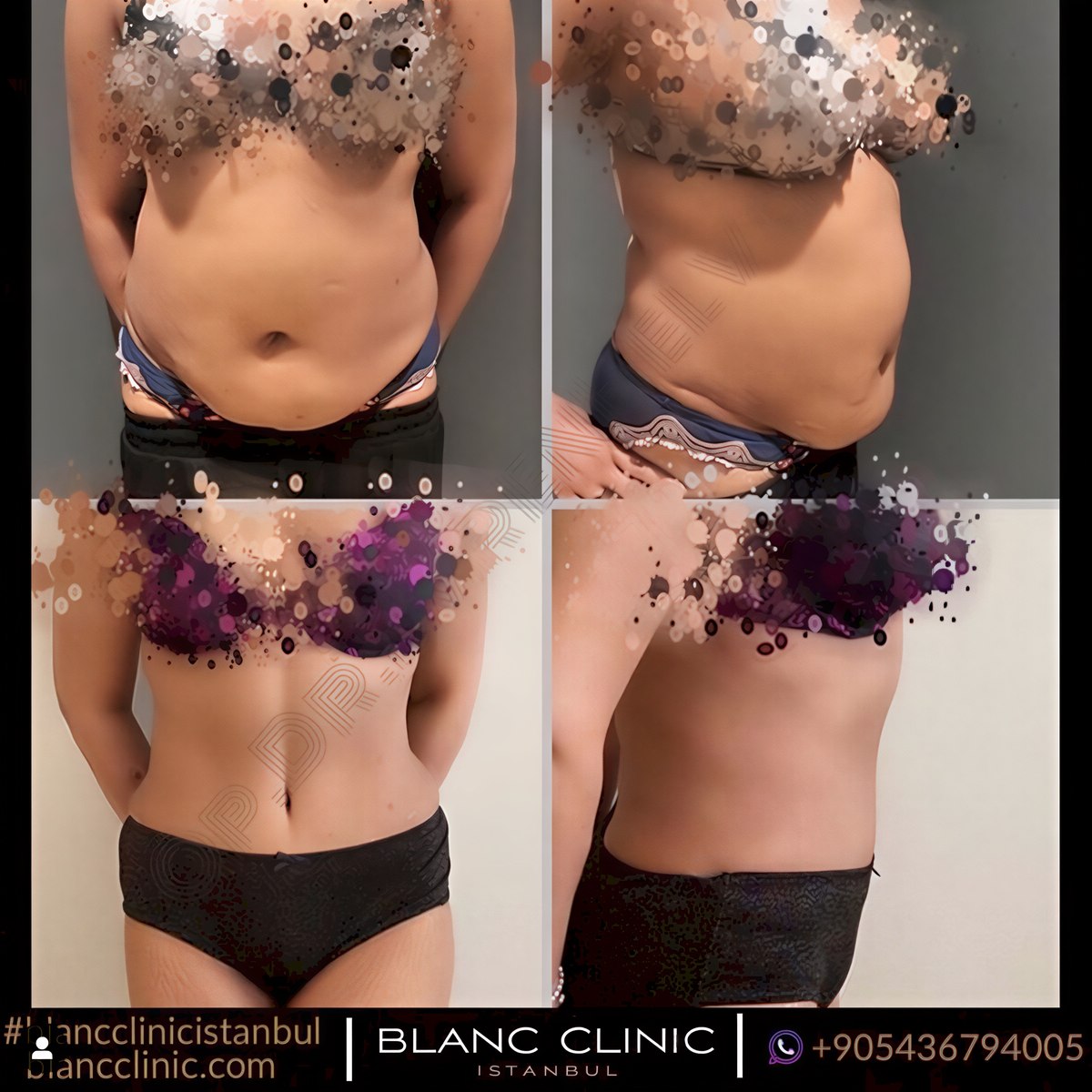 Resultados de abdominoplastia antes y después en Blanc Clinic&Beauty, mejora del abdomen
