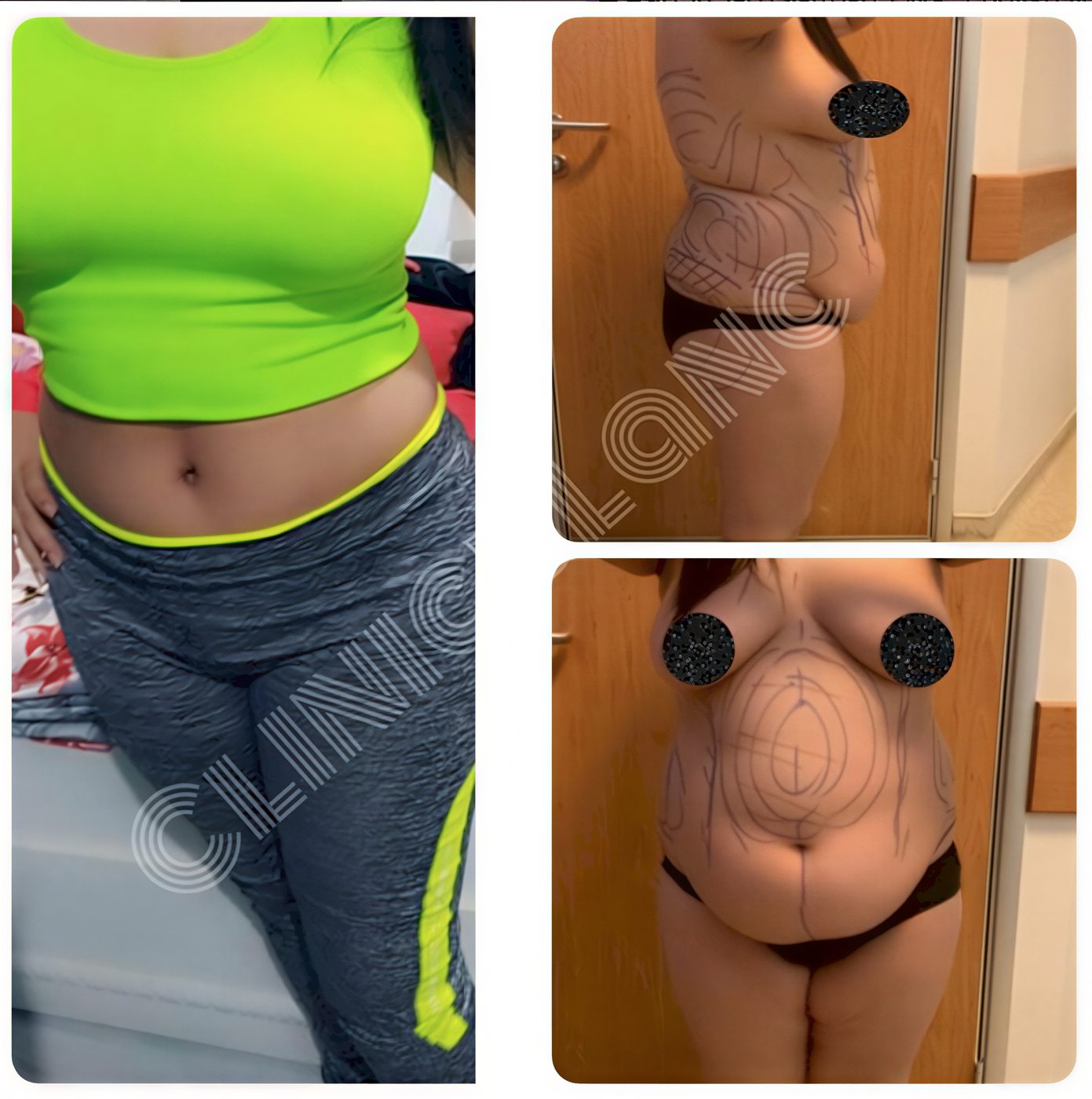 Resultados de abdominoplastia antes y después en Blanc Clinic&Beauty, mejora abdominal visible