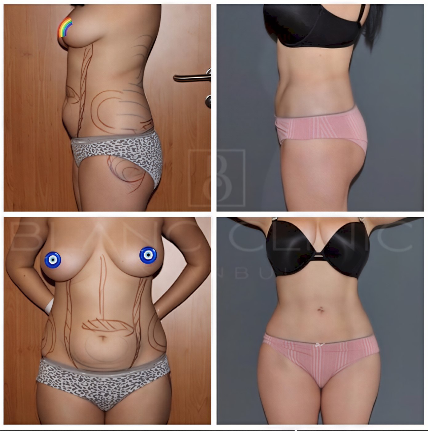Resultados de abdominoplastia antes y después en Blanc Clinic&Beauty, mejora abdominal visible