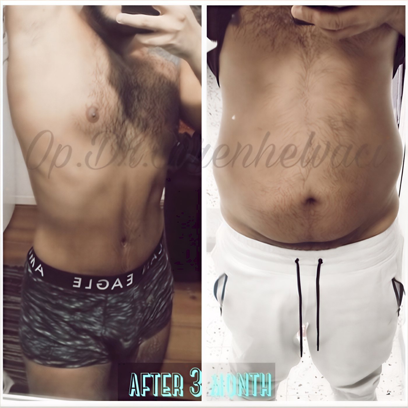 Resultados de abdominoplastia antes y después en Blanc Clinic&Beauty, mejora abdominal visible
