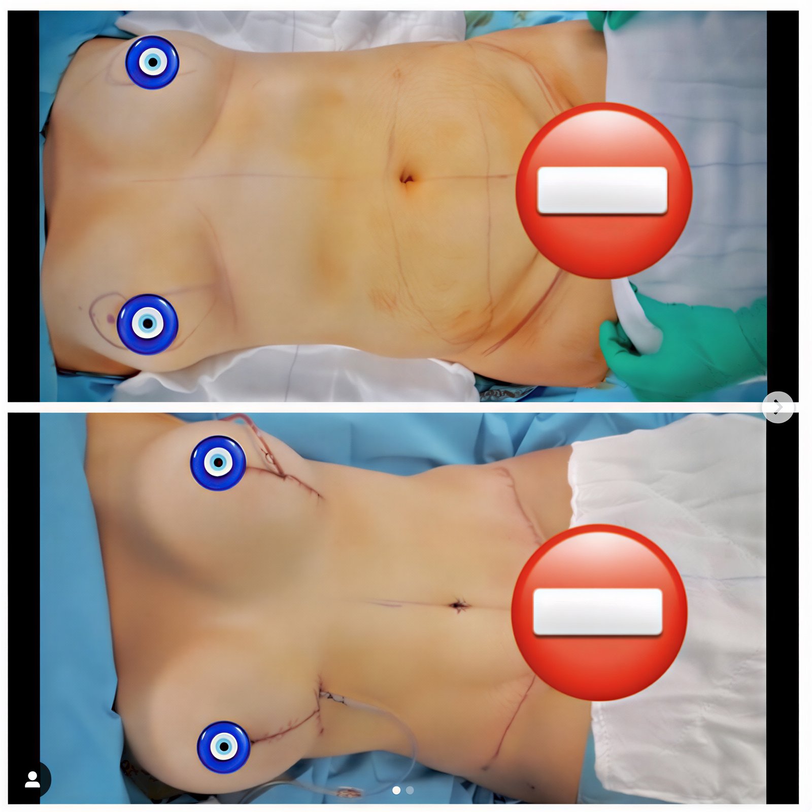Resultados de abdominoplastia antes y después en Blanc Clinic&Beauty, mejora del contorno abdominal